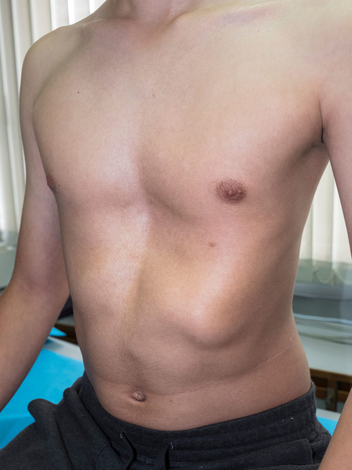 A male patient presenting a congenital deformity of the anterior thoracic wall referred to as Pectus Excavatum, or sunken chest.