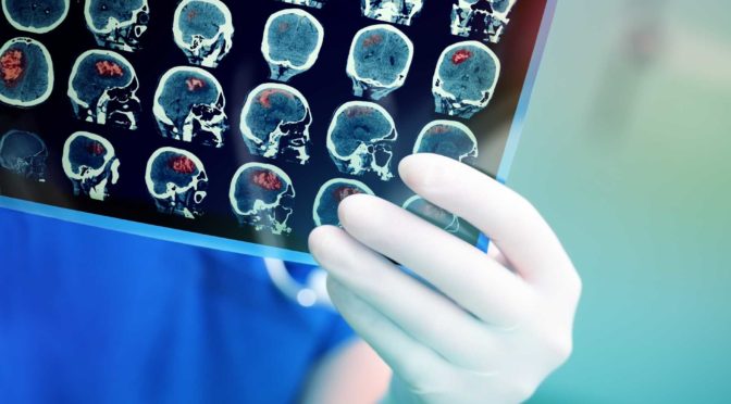 Doctor holds brain tumor images
