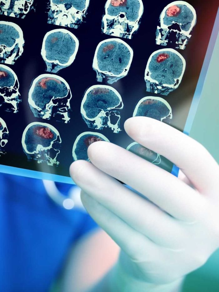 Doctor holds brain tumor images