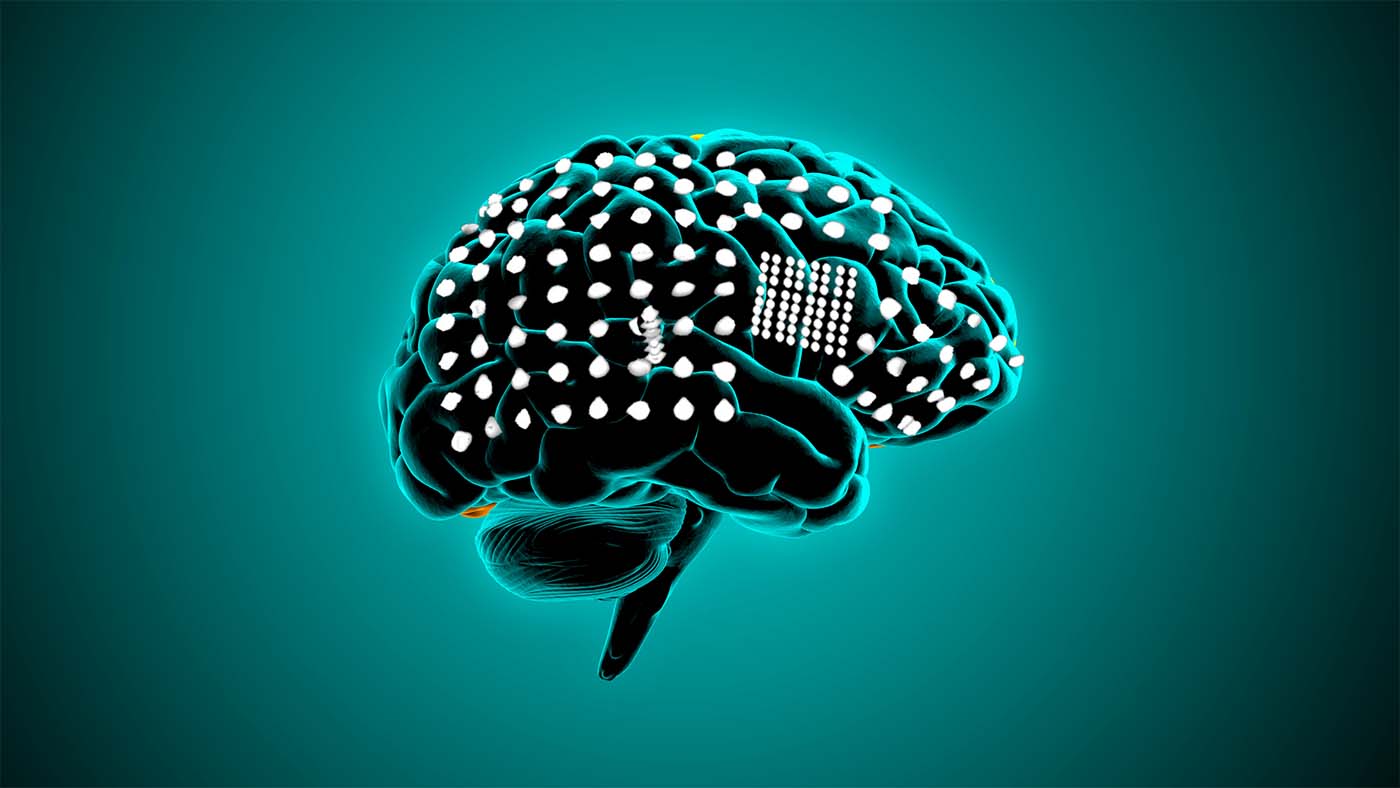 Imagine of brain depicts examples of standard intracranial grid with electrodes spaced 10 mm apart and a high-density grid of electrodes spaced 3 mm apart