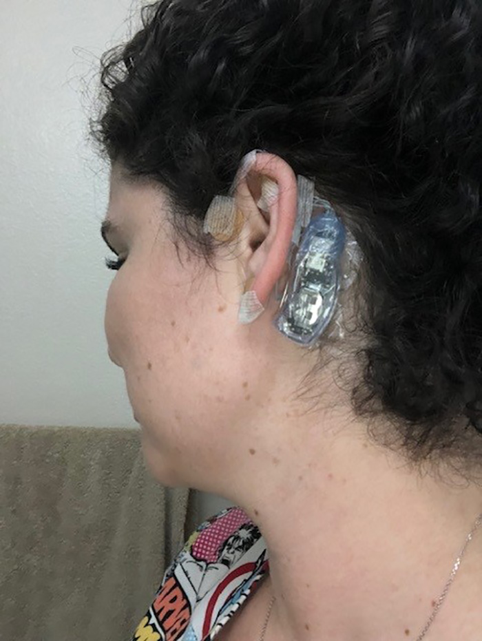 An image of Tayler's ear, wearing the IB-Stim device. 