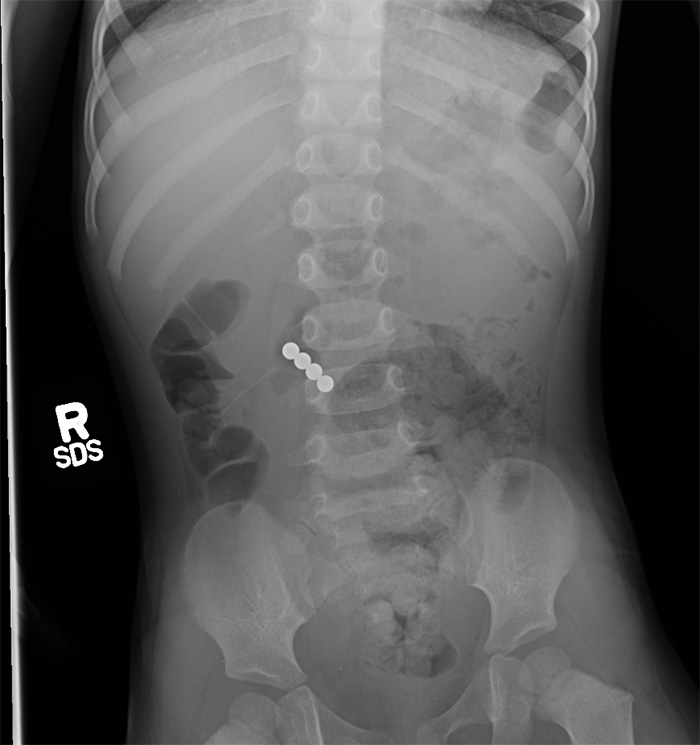 X-ray image that shows magnets in patient's belly 