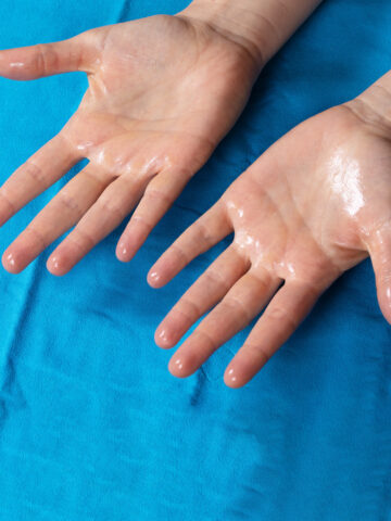 Excessively sweaty hands or palmar hyperhidrosis.