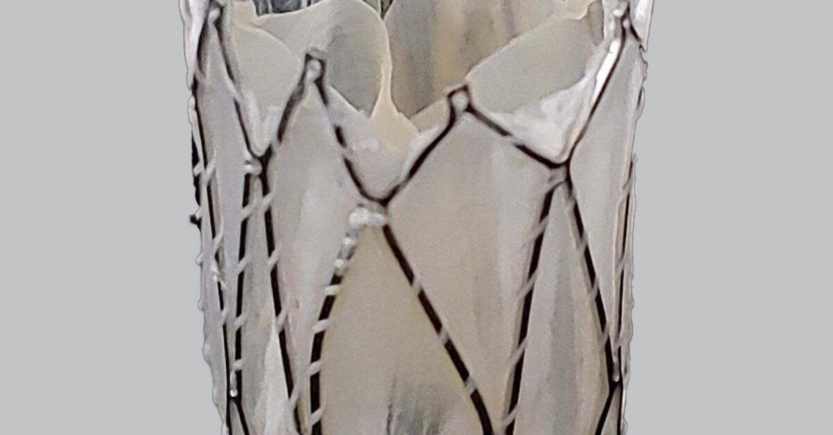 ‘First of its kind’ pulmonary valve ‘grows’ with patients CHOC Pediatrica