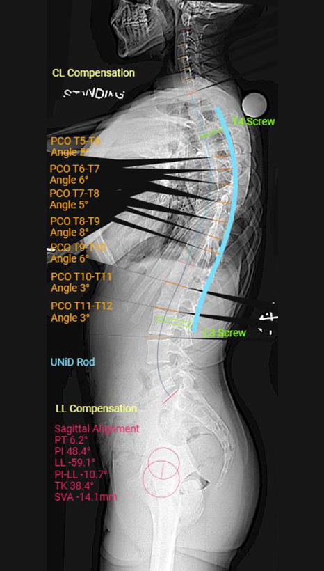 X-ray - Patient-specific rods to treat scoliosis 