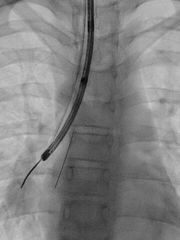 In record time, Rady Children’s Health in Orange County develops a leading pediatric advanced bronchoscopy program