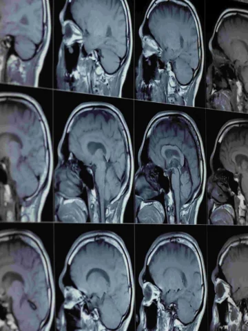 MRI brain images